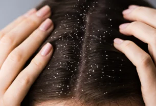 Close-up of scalp showing oil buildup and yeast causing dandruff flakes