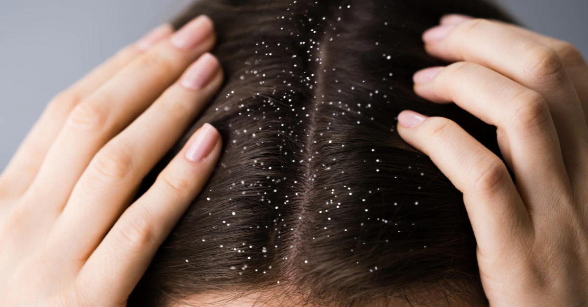 Close-up of scalp showing oil buildup and yeast causing dandruff flakes