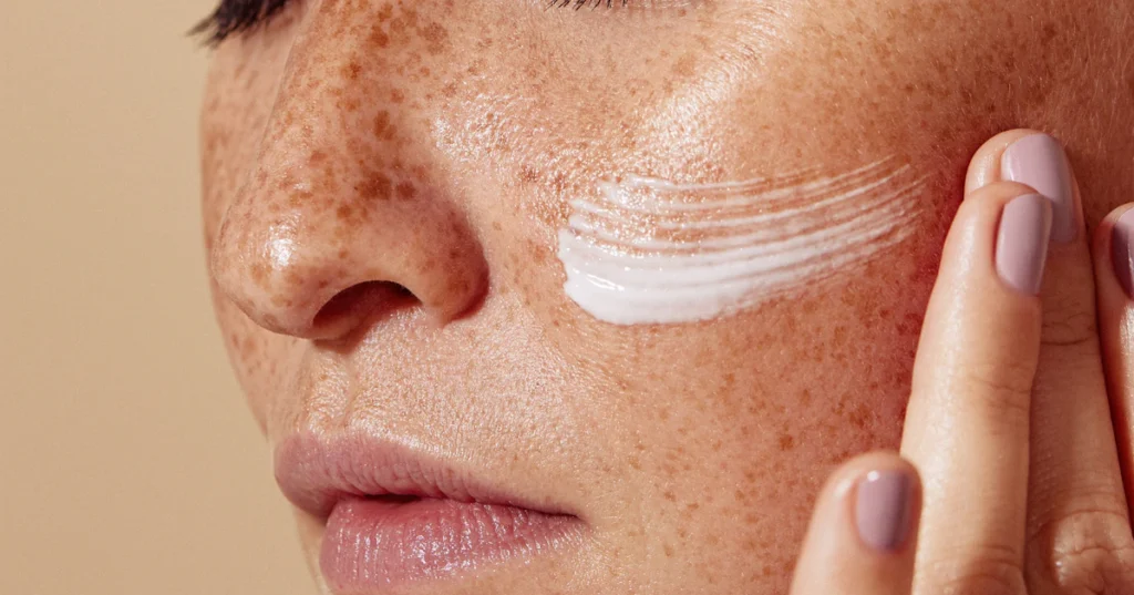 Close-up of a woman applying a white cream treatment to her cheek to help fade acne marks