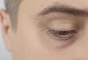 Close-up of a man's tired eye showing puffy skin underneath
