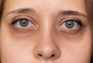 Woman with visible dark circles under her eyes