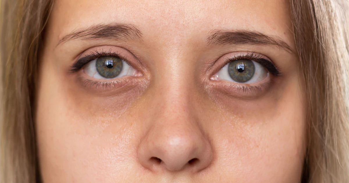 Woman with visible dark circles under her eyes